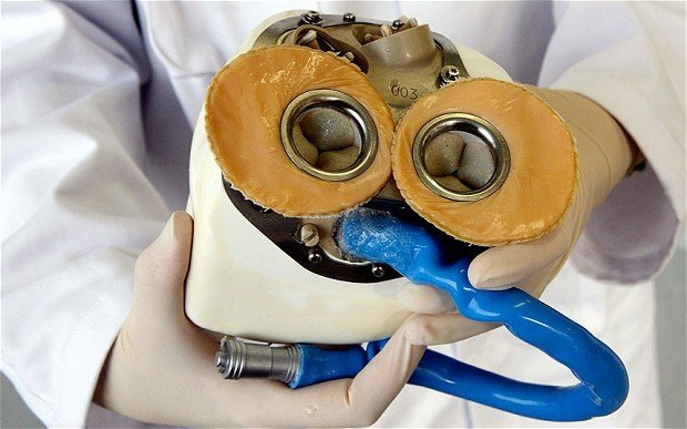 First artificial heart transplant in the history of medicine